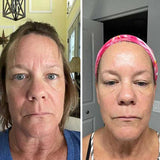 Frownies Forehead & Between Eyes Wrinkle Patches